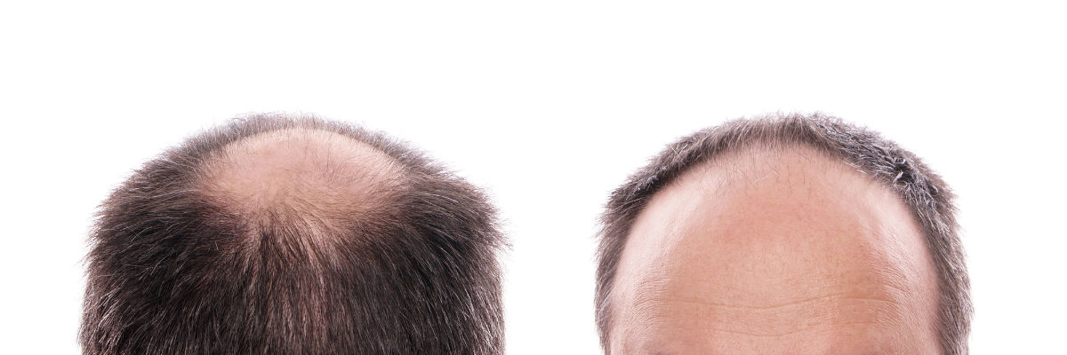 Receding Hairline: Stages, Causes, Prevention and Treatment Options 1 Receding Hairline: Stages, Causes, Prevention and Treatment Options 1
