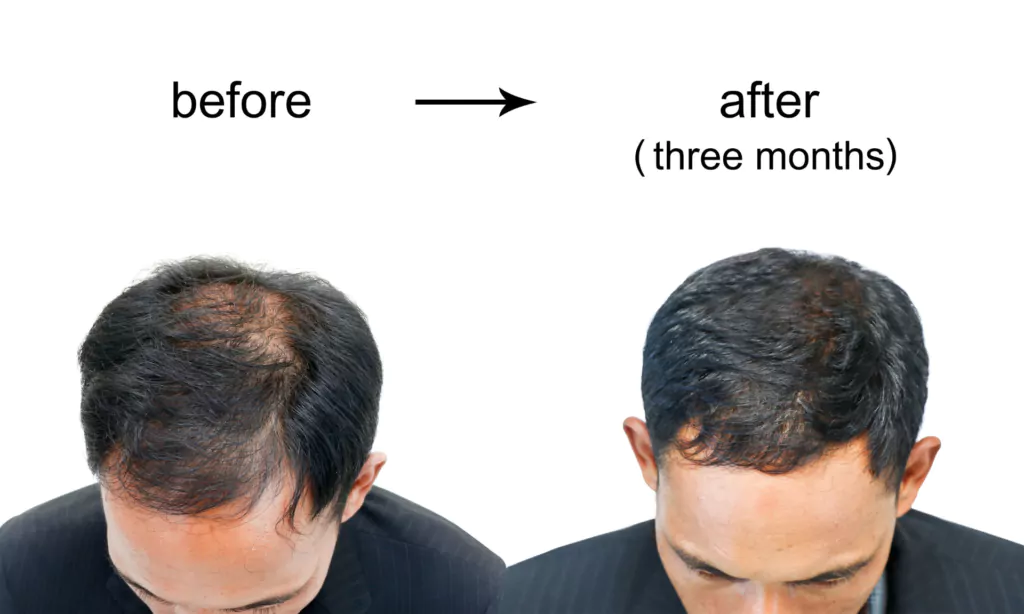 PRP before and after – See the results for yourself 1 PRP before and after – See the results for yourself 1